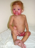 acrodermatitis enteropathica