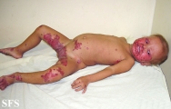 acrodermatitis enteropathica