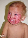 acrodermatitis enteropathica
