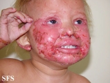 acrodermatitis enteropathica
