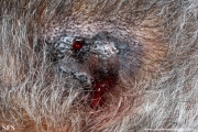 angiosarcoma