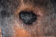 angiosarcoma