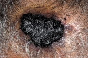 angiosarcoma