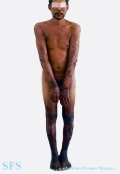 pellagra