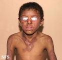 pellagra