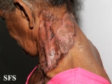 pellagra