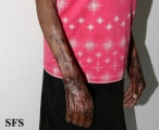 pellagra