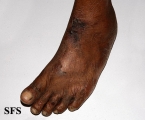 pellagra