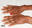 pellagra