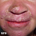 candidiasis chronic mucocutaneos