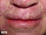 candidiasis chronic mucocutaneos