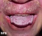 candidiasis chronic mucocutaneos