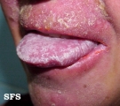 candidiasis chronic mucocutaneos