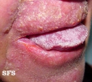 candidiasis chronic mucocutaneos