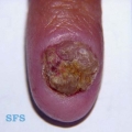 candidiasis chronic mucocutaneos