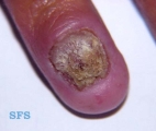candidiasis chronic mucocutaneos