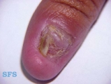 candidiasis chronic mucocutaneos