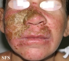 candidiasis chronic mucocutaneos