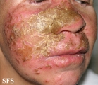candidiasis chronic mucocutaneos