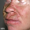 candidiasis chronic mucocutaneos