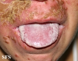 candidiasis chronic mucocutaneos