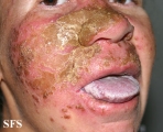 candidiasis chronic mucocutaneos