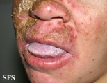 candidiasis chronic mucocutaneos