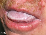 candidiasis chronic mucocutaneos