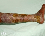 candidiasis chronic mucocutaneos