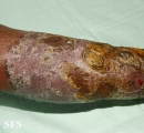 candidiasis chronic mucocutaneos