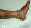 candidiasis chronic mucocutaneos