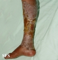 candidiasis chronic mucocutaneos