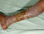 candidiasis chronic mucocutaneos
