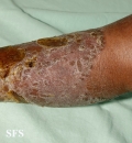 candidiasis chronic mucocutaneos