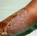 candidiasis chronic mucocutaneos