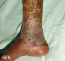 candidiasis chronic mucocutaneos