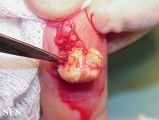tenosynovitis nodular