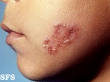 sarcoidosis