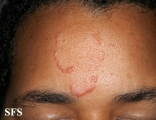 sarcoidosis