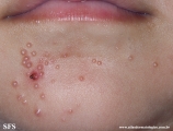 molluscum contagiosum