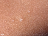 molluscum contagiosum