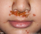 impetigo