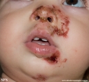 impetigo