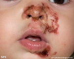 impetigo