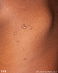 molluscum contagiosum