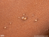 molluscum contagiosum