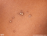 molluscum contagiosum