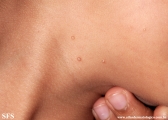 molluscum contagiosum