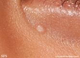 molluscum contagiosum