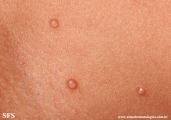 molluscum contagiosum